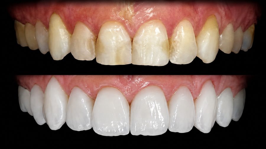 Caso de transformação de sorriso, antes e depois, na Implamix Odontologia