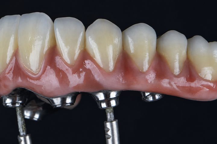 Prótese na Implamix Odontologia